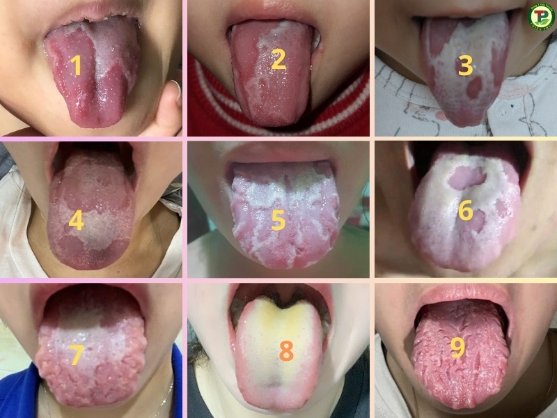 Các dạng nấm lưỡi, nấm miệng thường gặp